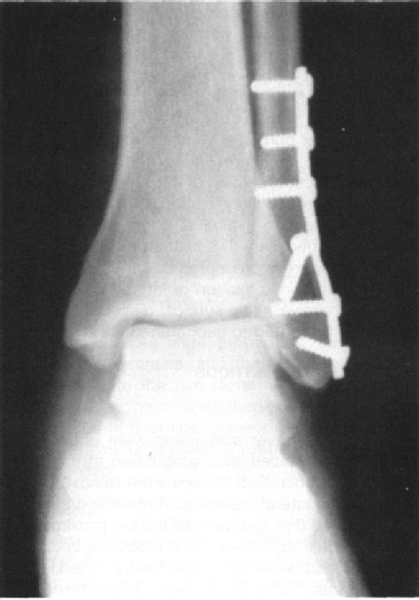 Figure 1 From Intramedullary Screw Fixation Of Lateral Malleolus