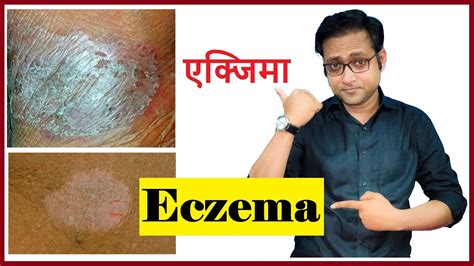 Nummular Eczema Treatment Hindi Youtube