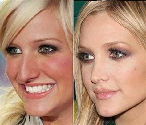 Celebrity Nose Jobs Before And After Celebrity Plastic Surgery Nose Job Cosmetic Surgery