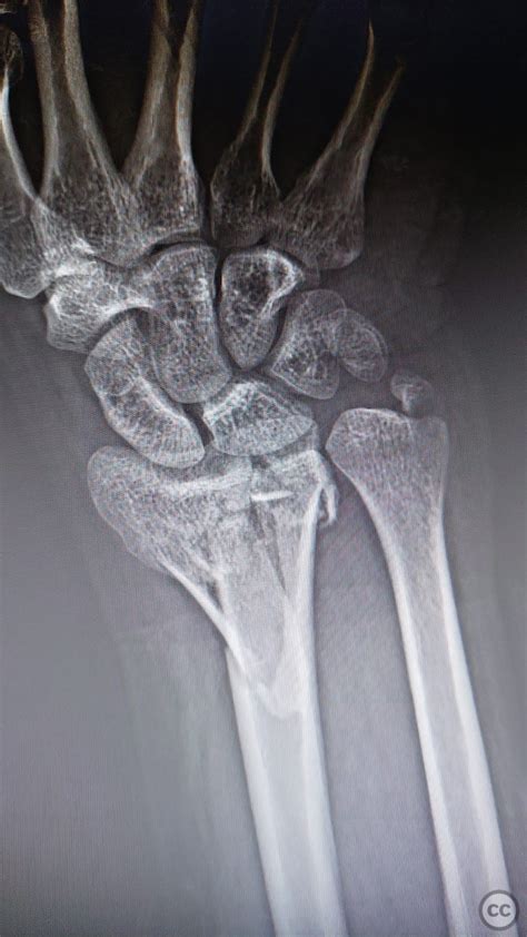 Distal Radius And Ulna Styloid Fracture