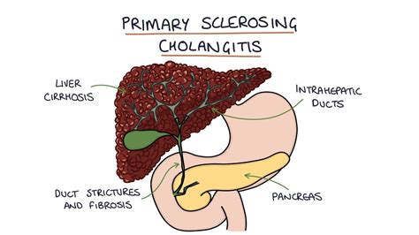 Primary Sclerosing Cholangitis Visual Explanation For Students Youtube