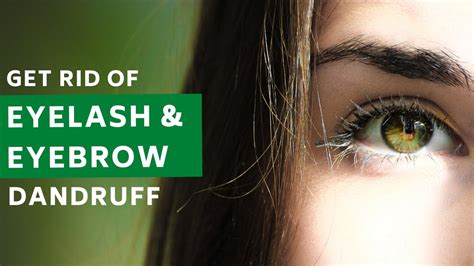 How To Remove Dandruff From Eyelashes And Eyebrows Naturally Just With