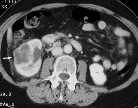 Renal Lymphoma Ct Patterns With Emphasis On Helical Ct Radiographics