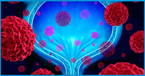 Most patients diagnosed with bladder cancer have cancer cells that begin to grow in the inner lining of the bladder. New Immunotherapy Breakthroughs in treating Bladder Cancer