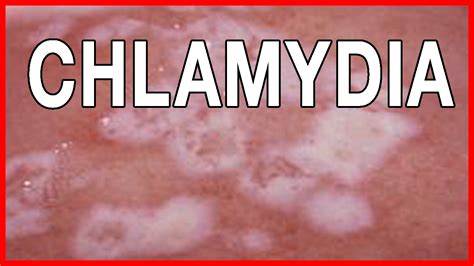 Signs And Symptoms Of Chlamydia How To Treat Chlamydia In Women And