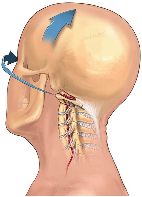 Cervical Arterial Dissections And Association With Cervical