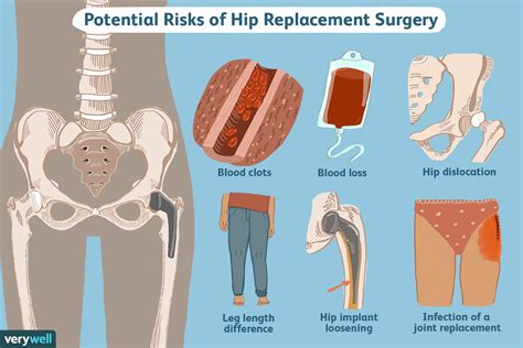 does your leg get shorter after hip replacement surgery