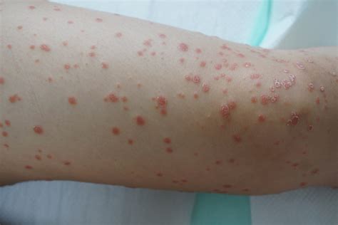 Psoriasis In Children Types Causes Symptoms And Treatment