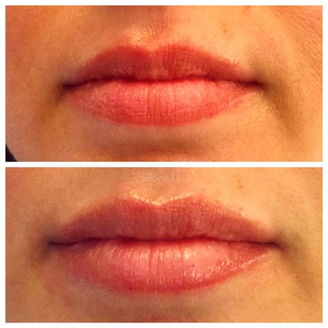 Juvederm Filled Lips Before And After Photos Dental Makeover