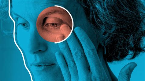 7 Signs And Symptoms Of Thyroid Eye Disease Graves Ophthalmopathy