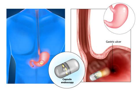 Capsule Endoscopy Non Invasive Diagnostic Procedure