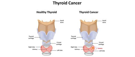 Thyroid Cancer Residency In Usa