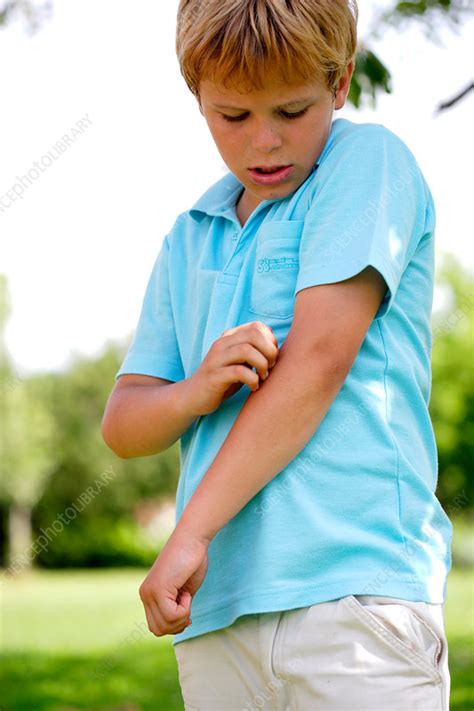 Boy Scratching His Arm Stock Image C0312100 Science Photo Library
