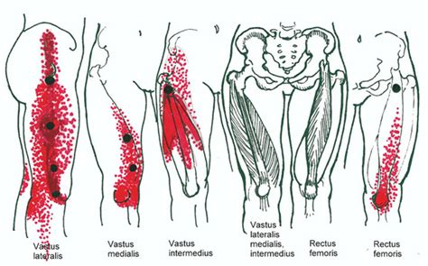 Chronic Pelvic And Low Back Pain Sharp Pain In Back Of Thigh When