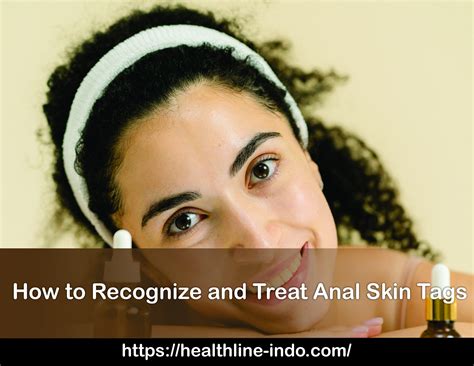 How To Recognize And Treat Anal Skin Tags Healthline Indonesia