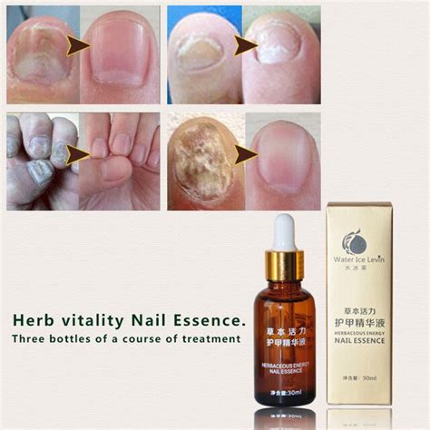 1pcs Water Ice Levin Fungal Nail Treatment Essence Nail And Foot