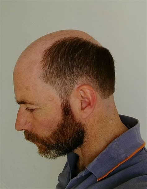 Pin By Cmb On Mpbilf Male Pattern Baldness Hairstyles Bald Men With