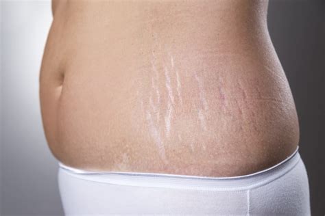 the essential guide to stretch mark treatment in singapore 2020 doctorxdentist