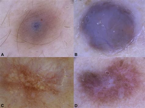 The Dermoscopic Variability Of Dermatofibromas Journal Of The