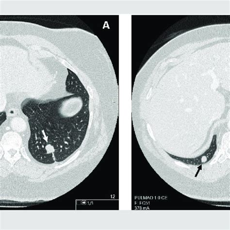 Chest Computed Tomography Ct Revealing The 2 Pulmonary Nodules