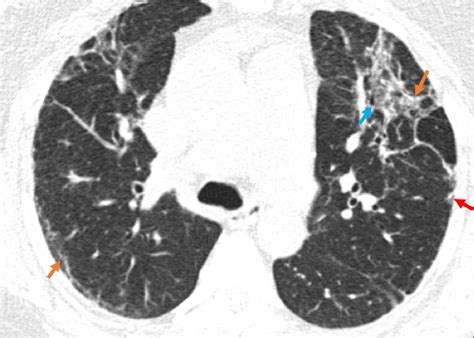 Figure 5 From Imaging Features Of Idiopathic Pulmonary Fibrosis A