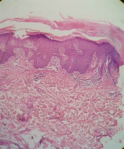 Histopathology 10x View Hande Stain Of Scalp Lesion Showing Marked