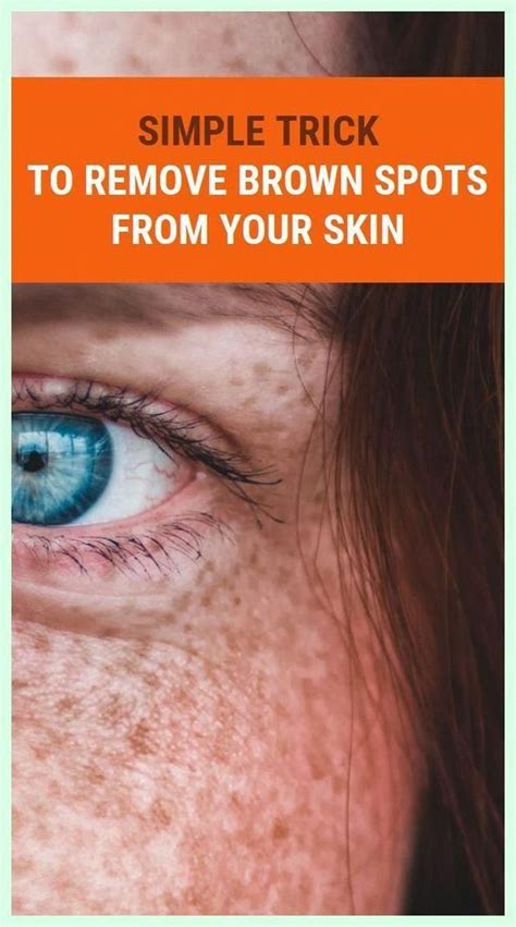 Simple Trick To Remove Brown Spots From Your Skin In 2022 Brown Spots On Face Spots On Face