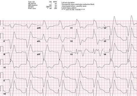 Hyperkalemia EKG K Of Heres An ECG Of A Man GrepMed 4437 The Best