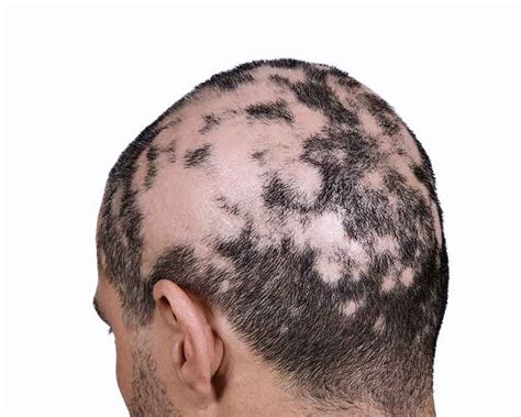 Alopecia Areata Treatment Symptoms Risk Factors Causes And Types
