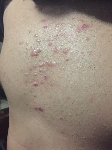 Acne My Friends Chest Is Covered In Cystic Acne Can You Guys