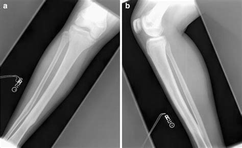 Titanium Elastic Nails For Pediatric Tibial Shaft Fractures Springerlink