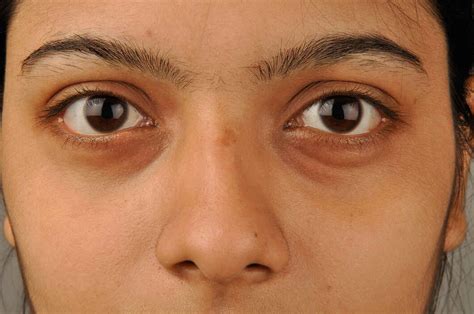 Puffy Eyes Meaning Symptoms Causes And Treatments