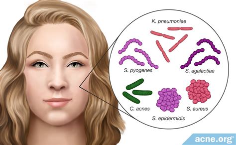 Do Different Strains Of Acne Bacteria Affect Acne Differently