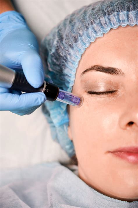Microneedling Facial Treatment Reading Crysallis Skin Clinic