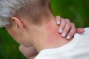 What To Know About Stress-Induced Hives and Rashes