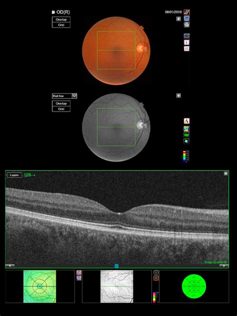 What Is An Oct Scan Dipple And Conway