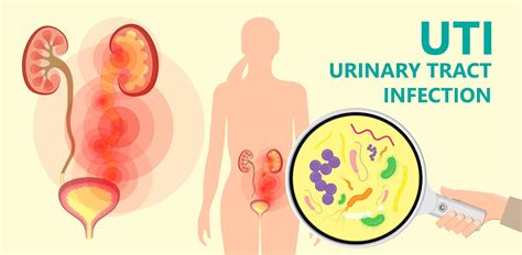 Urinary Tract Infections Symptoms And Complications Off