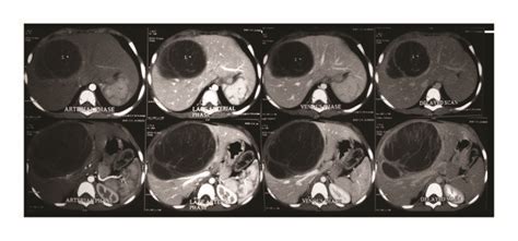 Triple Phase Ct Scan Notable For A Near Water Attenuating Cyst