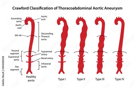 Vetor De Crawford Classification Of Thoracoabdominal Aortic Aneurysms