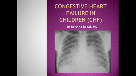 Congestive Heart Failure In Children Youtube