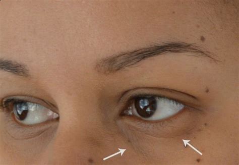 Trying To Get Rid Off Under Eye Lines Using Triabeauty Age Defying