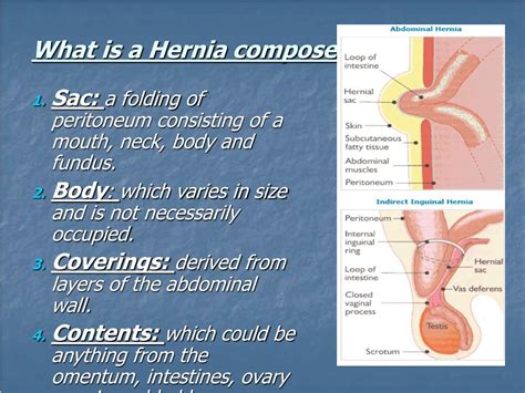 Ppt Hernias Powerpoint Presentation Free Download Id503397