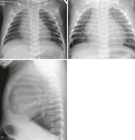 Chest Radiography In Pediatric Cardiovascular Disease Radiology Key