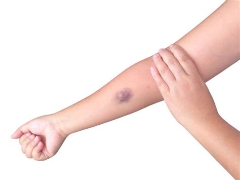2300 Bruise Arm Stock Photos Pictures And Royalty Free Images Istock