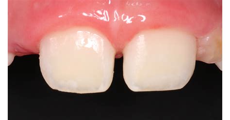 Icon Treatment For 7 Year Old Girl With Incisor Hypomineralization