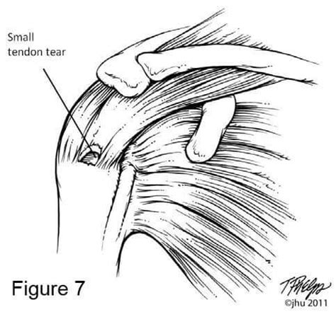 Failed Rotator Cuff Repairs Johns Hopkins Department Of Orthopaedic