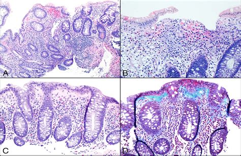 Symptomatic Microscopic Colitis Atop Quiescent Inflammatory Acg