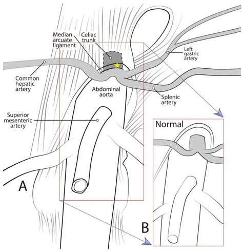 The median arcuate ligament is a ligament formed at the base of the diaphragm where the left and right diaphragmatic crura join near the 12th thoracic vertebra. Diagnostics | Free Full-Text | The Roles of Celiac Trunk ...