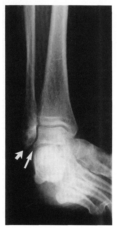 Figure 5 From Impingement Exostoses Of The Talus And Fibula Secondary