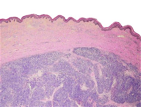 Hematoxylin And Eosin Slide 2×10 Merkel Cell Carcinoma Notes Dermal